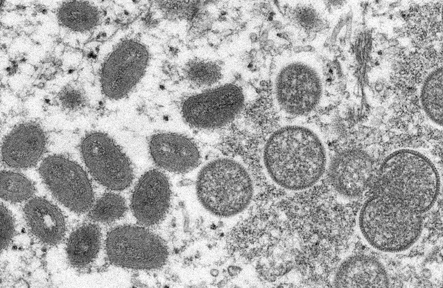 Brasil tem 2 casos suspeitos de varíola dos macacos, diz governo